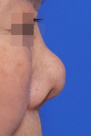 Kobijou Rhinoplasty Clinic: Side view, before. Original eye masking retained.